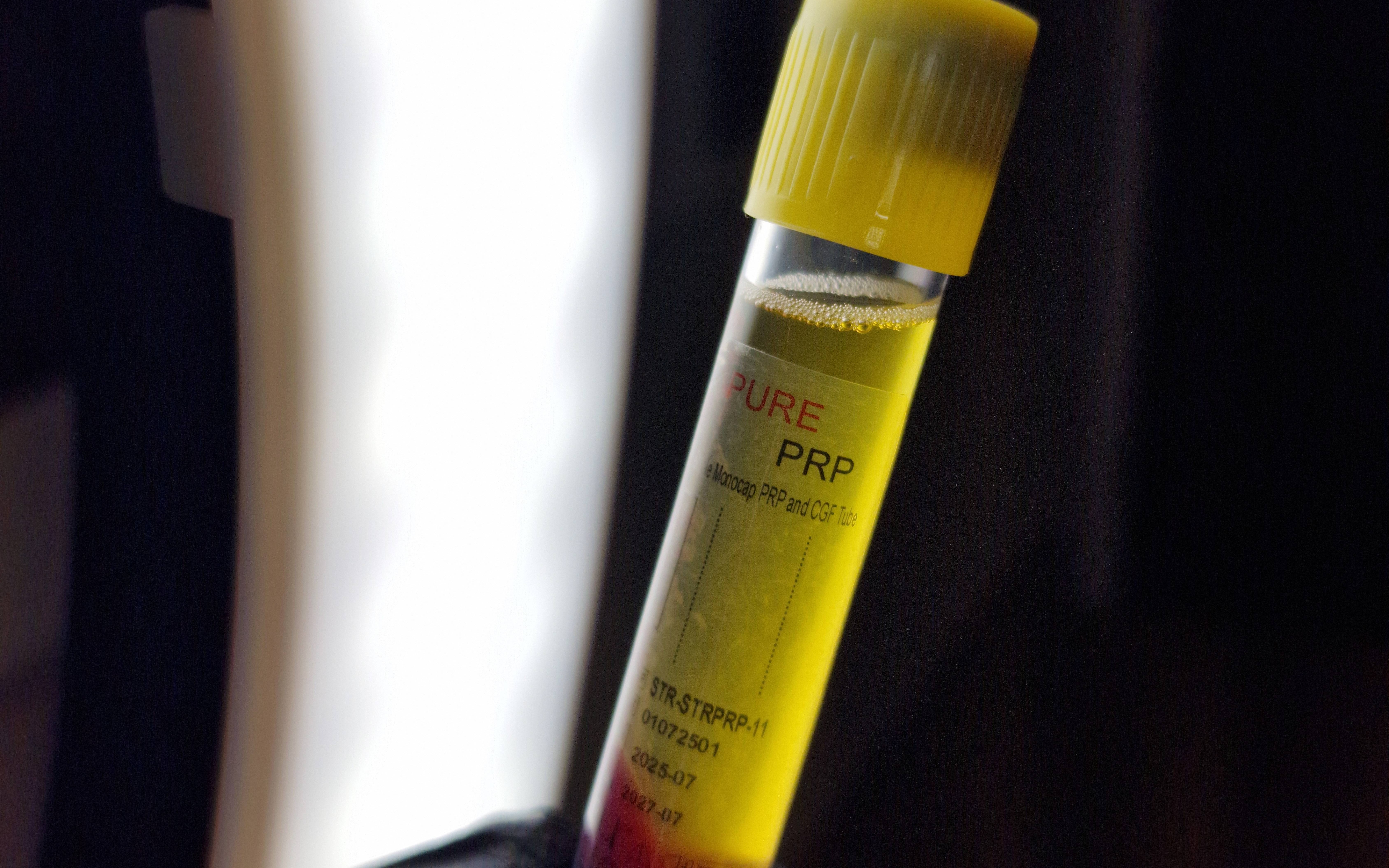 PRP Hair Restoration